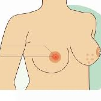 Hỏi Đáp Về Dấu Hiệu Ung Thư Vú